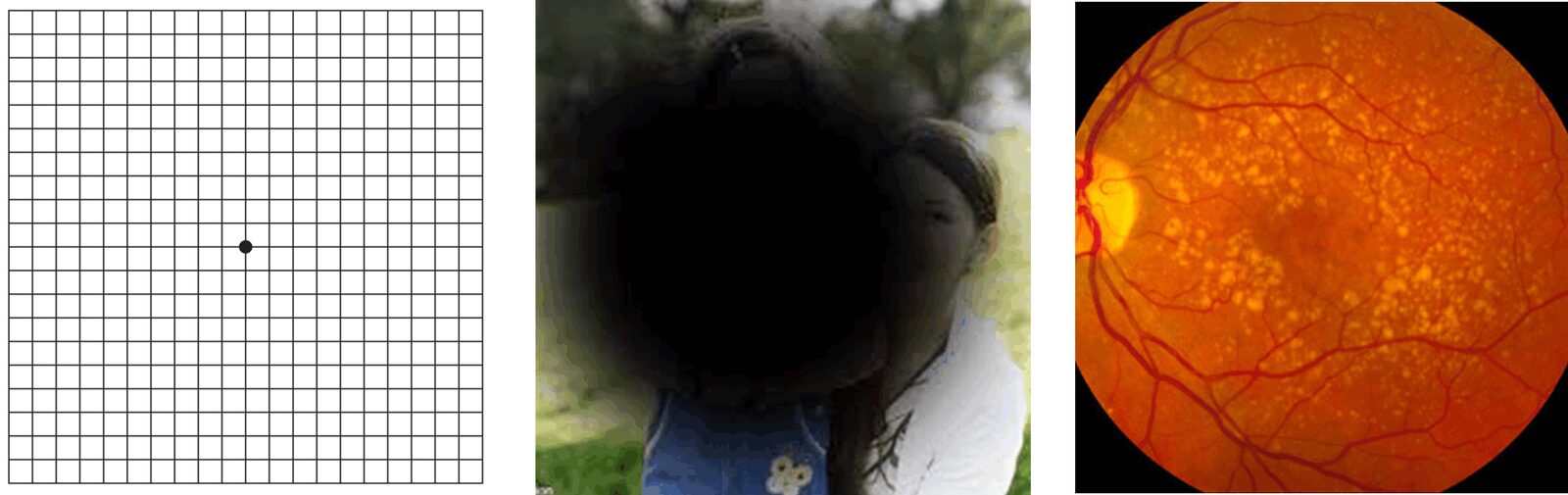 photo - macular degeneration